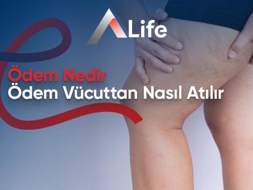 Ödem Nedir? Ödem Vücuttan Nasıl Atılır?